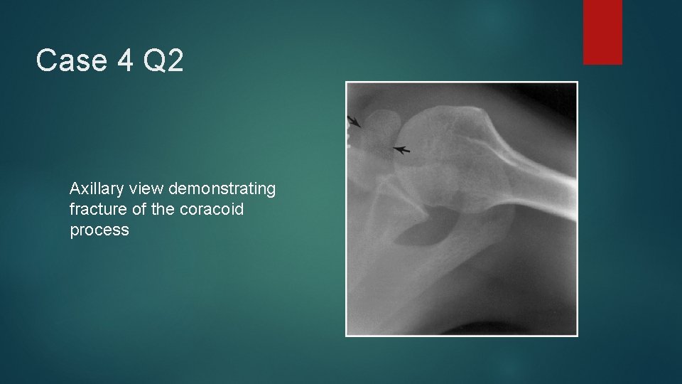 Case 4 Q 2 Axillary view demonstrating fracture of the coracoid process 