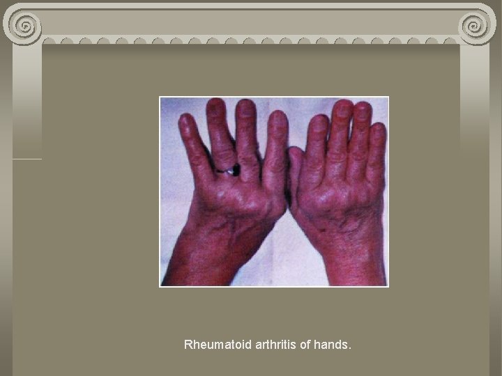 Rheumatoid arthritis of hands. 
