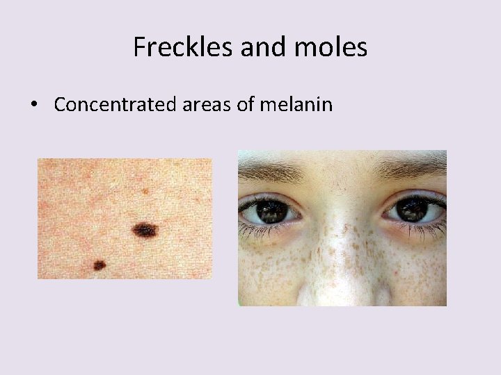 Freckles and moles • Concentrated areas of melanin 