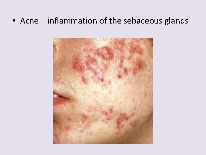  • Acne – inflammation of the sebaceous glands 