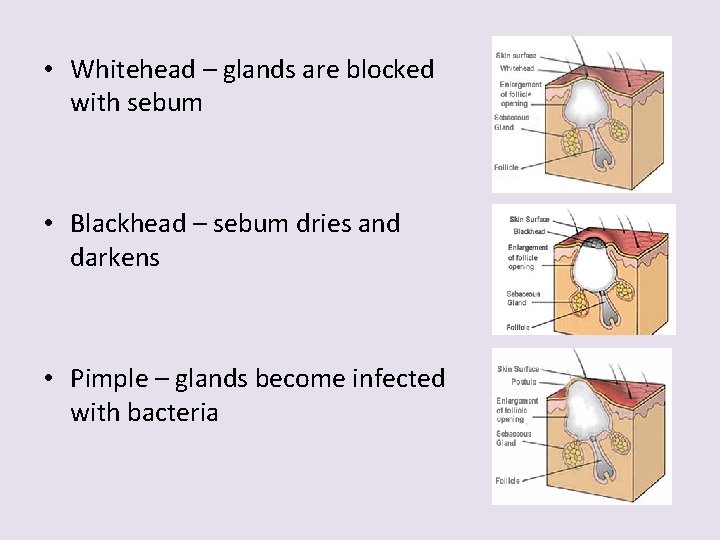  • Whitehead – glands are blocked with sebum • Blackhead – sebum dries