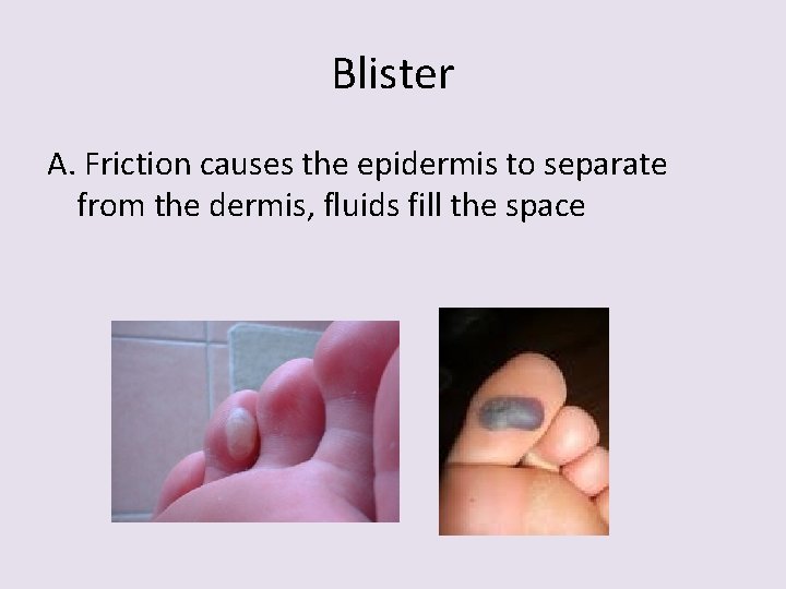 Blister A. Friction causes the epidermis to separate from the dermis, fluids fill the
