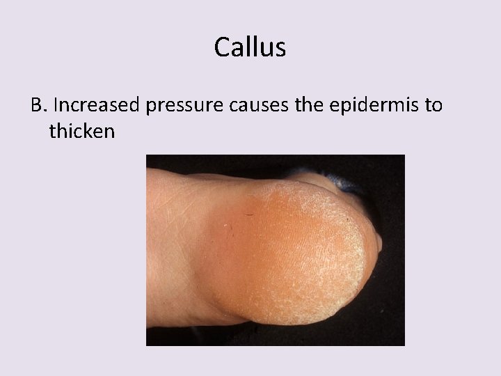 Callus B. Increased pressure causes the epidermis to thicken 