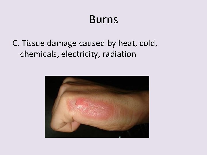 Burns C. Tissue damage caused by heat, cold, chemicals, electricity, radiation 