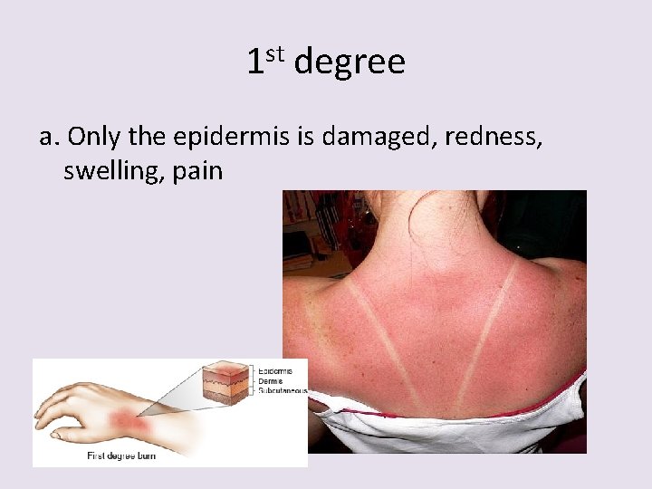 1 st degree a. Only the epidermis is damaged, redness, swelling, pain 