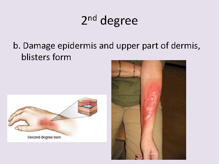 2 nd degree b. Damage epidermis and upper part of dermis, blisters form 