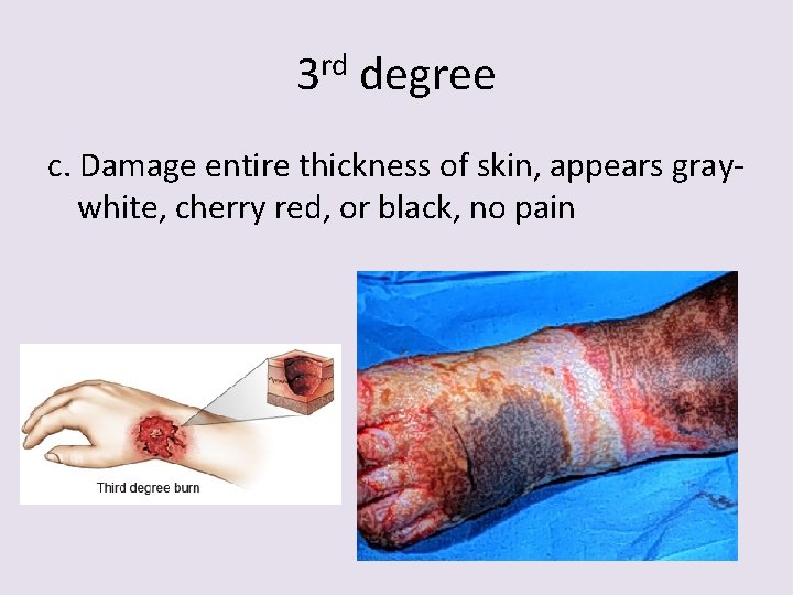 3 rd degree c. Damage entire thickness of skin, appears graywhite, cherry red, or