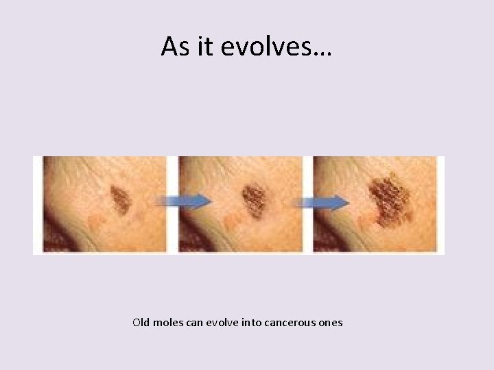 As it evolves… Old moles can evolve into cancerous ones 