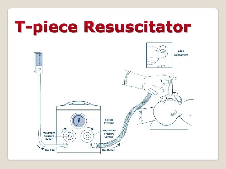 T-piece Resuscitator 