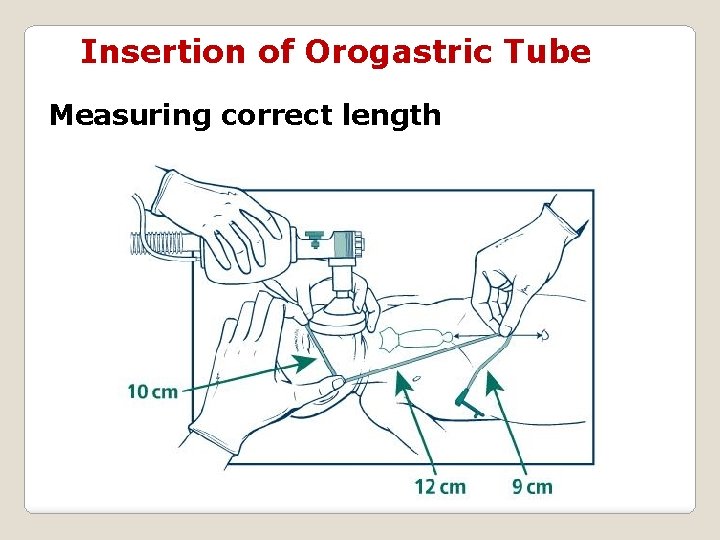 Insertion of Orogastric Tube Measuring correct length 