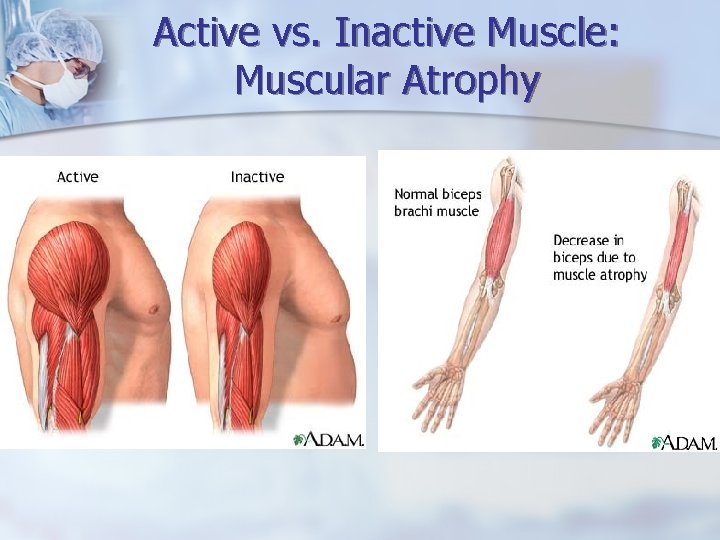Active vs. Inactive Muscle: Muscular Atrophy 