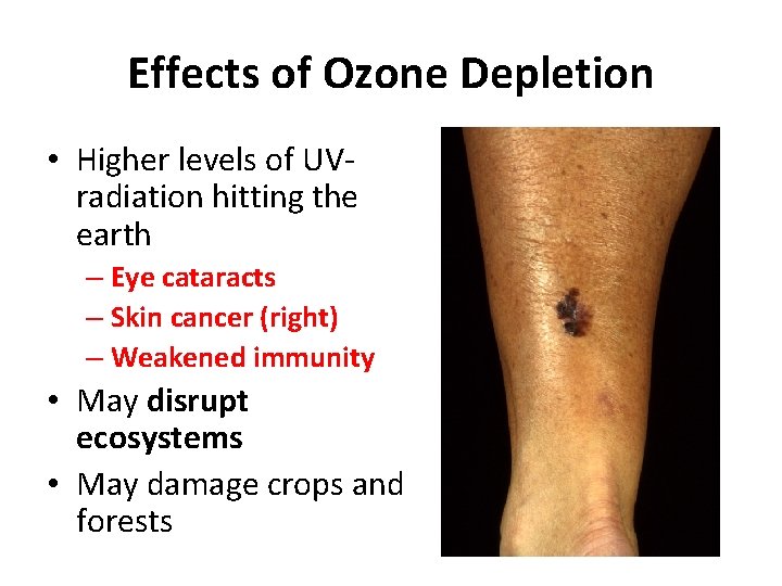 Effects of Ozone Depletion • Higher levels of UVradiation hitting the earth – Eye