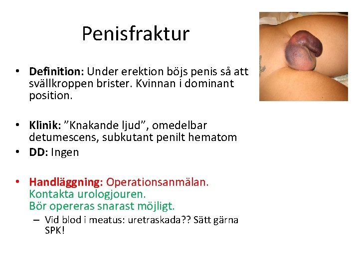 Penisfraktur • Definition: Under erektion böjs penis så att svällkroppen brister. Kvinnan i dominant