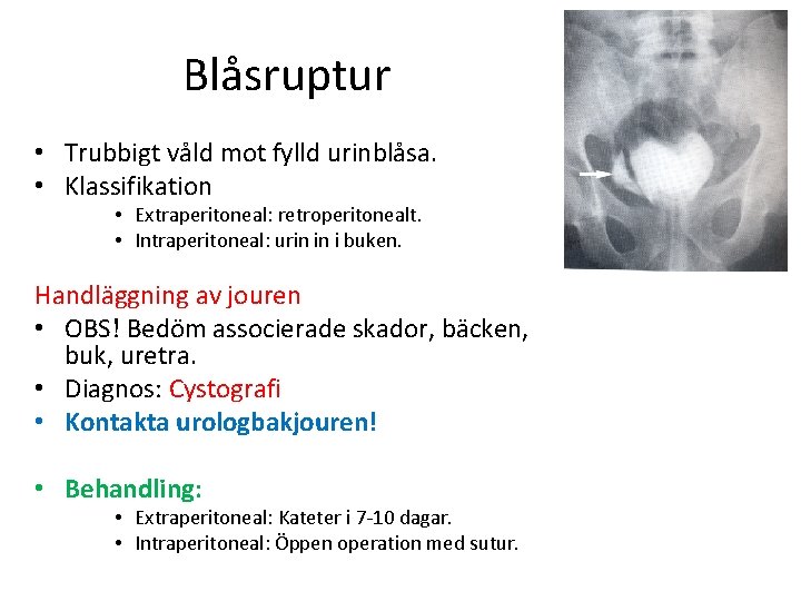 Blåsruptur • Trubbigt våld mot fylld urinblåsa. • Klassifikation • Extraperitoneal: retroperitonealt. • Intraperitoneal: