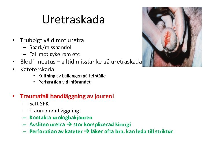 Uretraskada • Trubbigt våld mot uretra – Spark/misshandel – Fall mot cykelram etc •