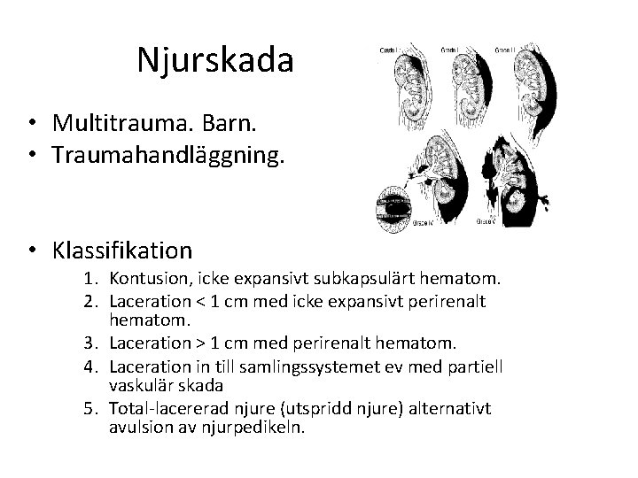 Njurskada • Multitrauma. Barn. • Traumahandläggning. • Klassifikation 1. Kontusion, icke expansivt subkapsulärt hematom.