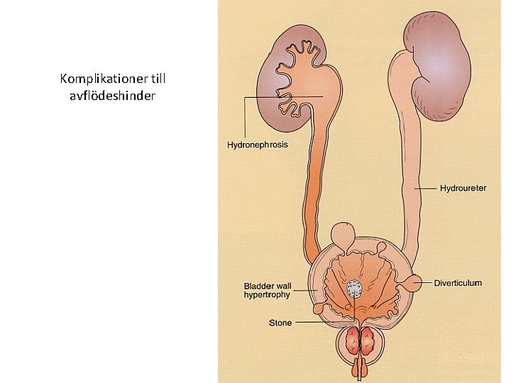 Komplikationer till avflödeshinder 26 Namn Efternamn 19 februari 2021 