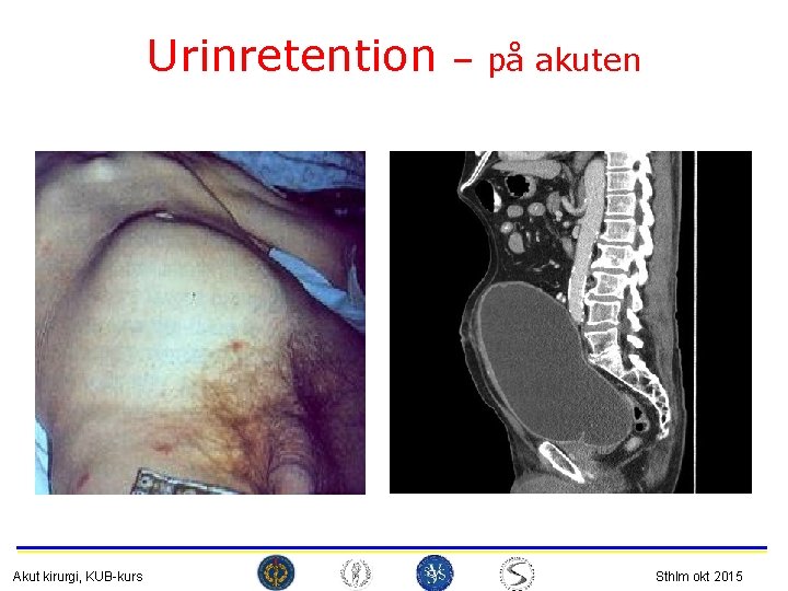 Urinretention Akut kirurgi, KUB-kurs – på akuten Sthlm okt 2015 