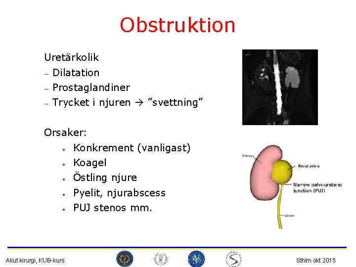 Obstruktion Uretärkolik — — — Dilatation Prostaglandiner Trycket i njuren ”svettning” Orsaker: • Konkrement