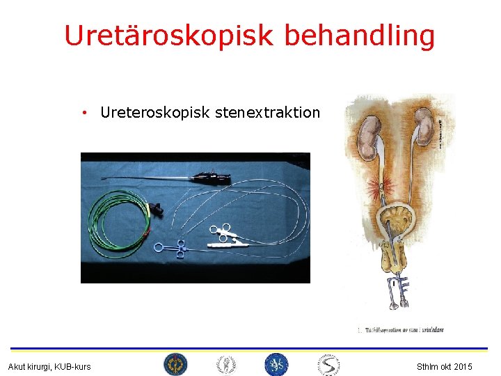 Uretäroskopisk behandling • Ureteroskopisk stenextraktion Akut kirurgi, KUB-kurs Sthlm okt 2015 