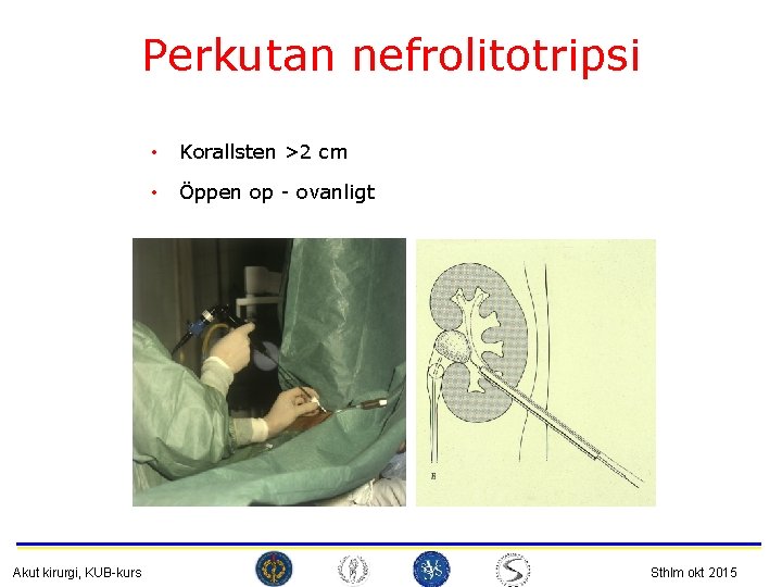 Perkutan nefrolitotripsi Akut kirurgi, KUB-kurs • Korallsten >2 cm • Öppen op - ovanligt
