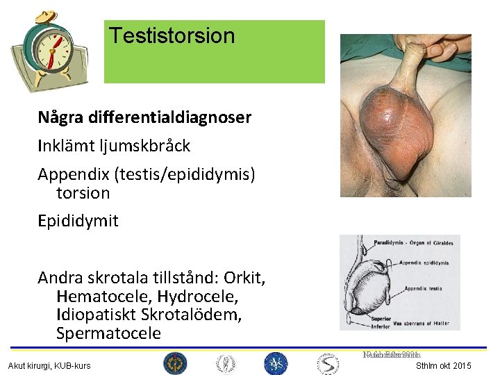 Testistorsion Några differentialdiagnoser Inklämt ljumskbråck Appendix (testis/epididymis) torsion Epididymit Andra skrotala tillstånd: Orkit, Hematocele,