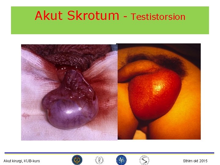Akut Skrotum - Testistorsion Akut kirurgi, KUB-kurs Sthlm okt 2015 