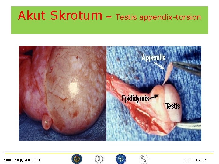 Akut Skrotum – Testis appendix-torsion Akut kirurgi, KUB-kurs Sthlm okt 2015 