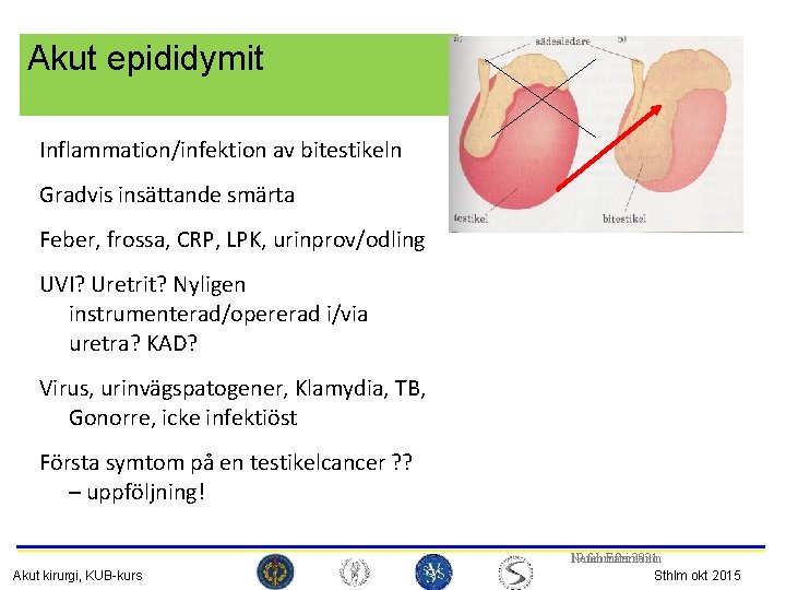 Akut epididymit Inflammation/infektion av bitestikeln Gradvis insättande smärta Feber, frossa, CRP, LPK, urinprov/odling UVI?