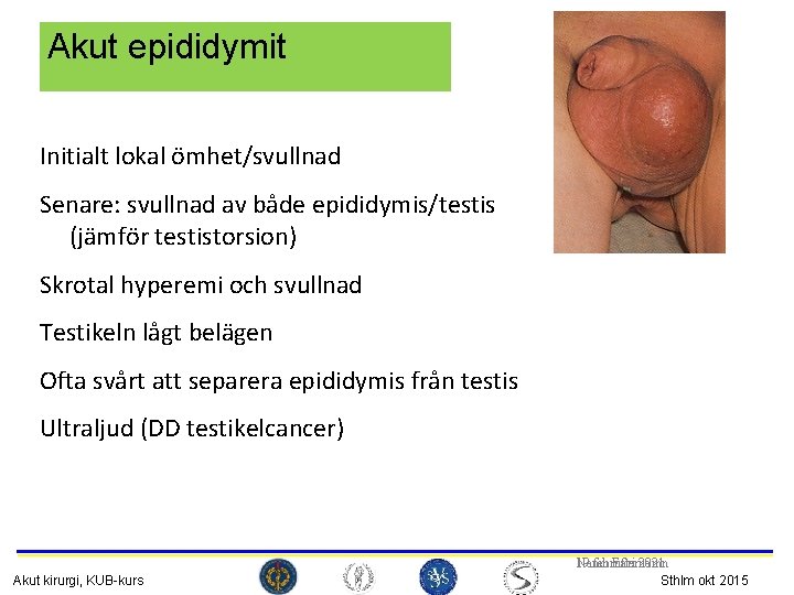 Akut epididymit Initialt lokal ömhet/svullnad Senare: svullnad av både epididymis/testis (jämför testistorsion) Skrotal hyperemi