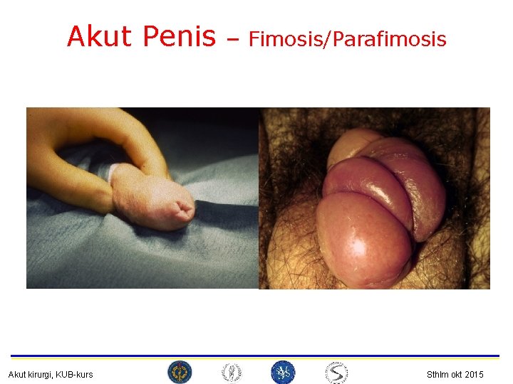 Akut Penis Akut kirurgi, KUB-kurs – Fimosis/Parafimosis Sthlm okt 2015 