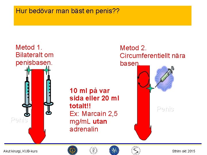 Hur bedövar man bäst en penis? ? Metod 1. Bilateralt om penisbasen. Penis Akut