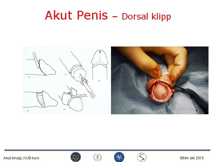 Akut Penis Akut kirurgi, KUB-kurs – Dorsal klipp Sthlm okt 2015 