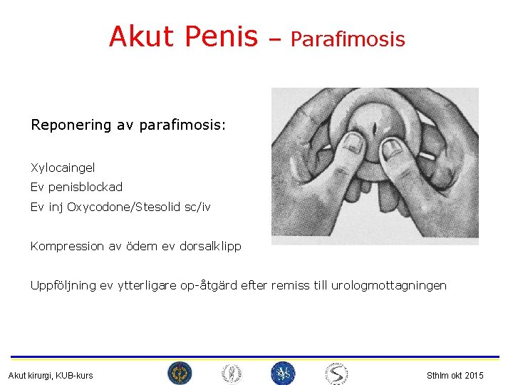 Akut Penis – Parafimosis Reponering av parafimosis: Xylocaingel Ev penisblockad Ev inj Oxycodone/Stesolid sc/iv