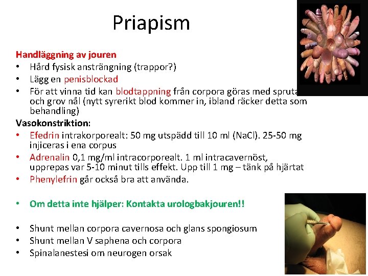 Priapism Handläggning av jouren • Hård fysisk ansträngning (trappor? ) • Lägg en penisblockad