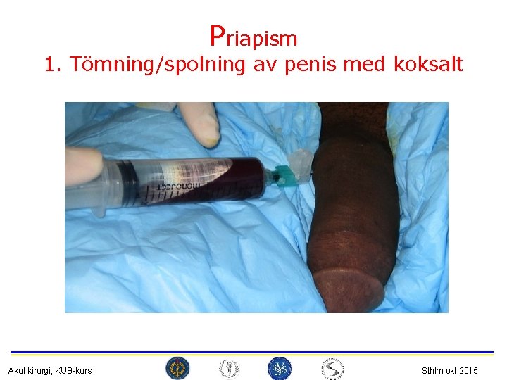 Priapism 1. Tömning/spolning av penis med koksalt Akut kirurgi, KUB-kurs Sthlm okt 2015 