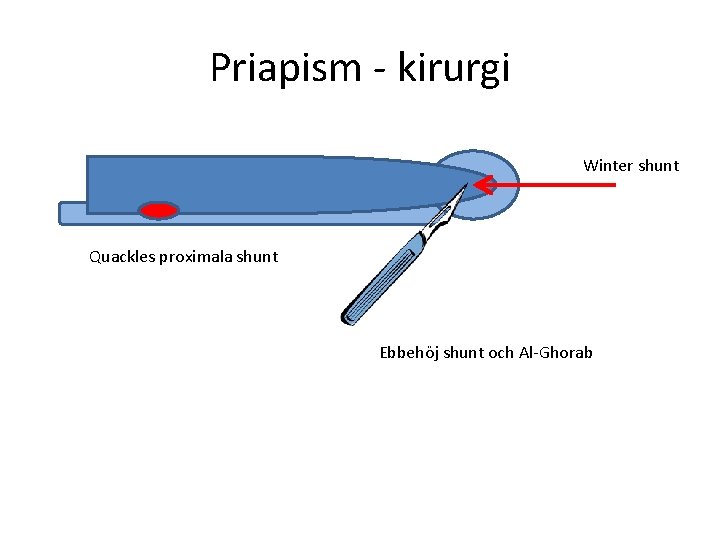 Priapism - kirurgi Winter shunt Quackles proximala shunt Ebbehöj shunt och Al-Ghorab 