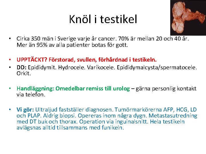 Knöl i testikel • Cirka 350 män i Sverige varje år cancer. 70% är