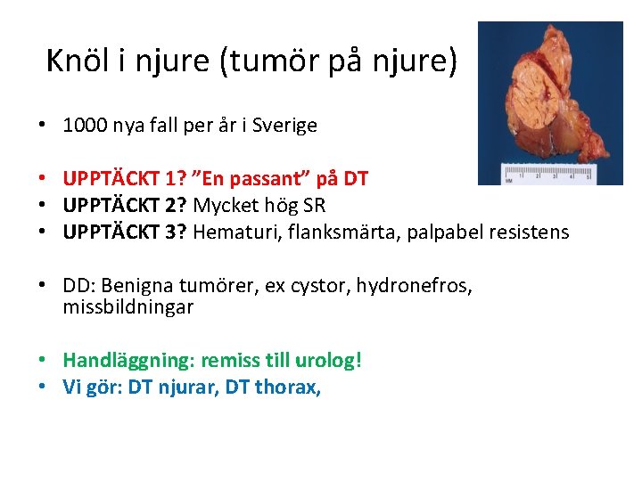 Knöl i njure (tumör på njure) • 1000 nya fall per år i Sverige