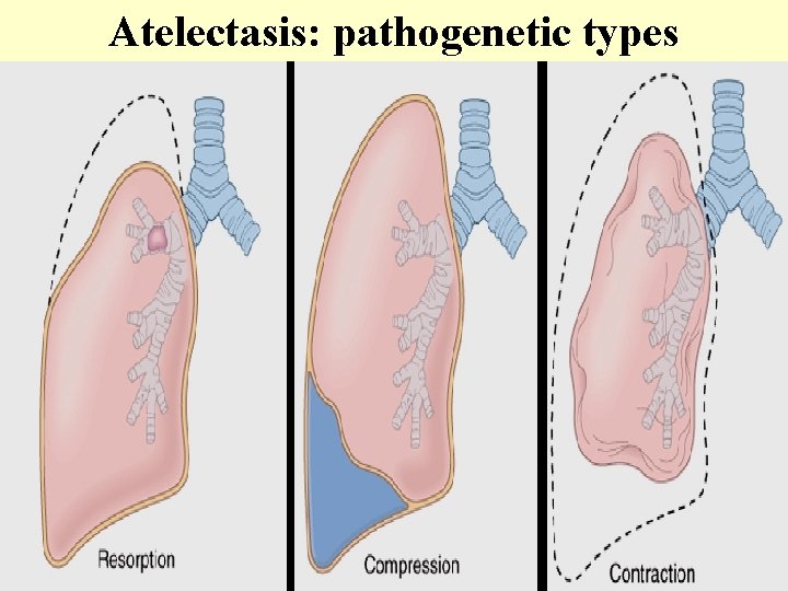 Atelectasis: pathogenetic types d 