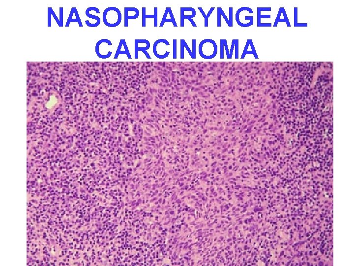 NASOPHARYNGEAL CARCINOMA 