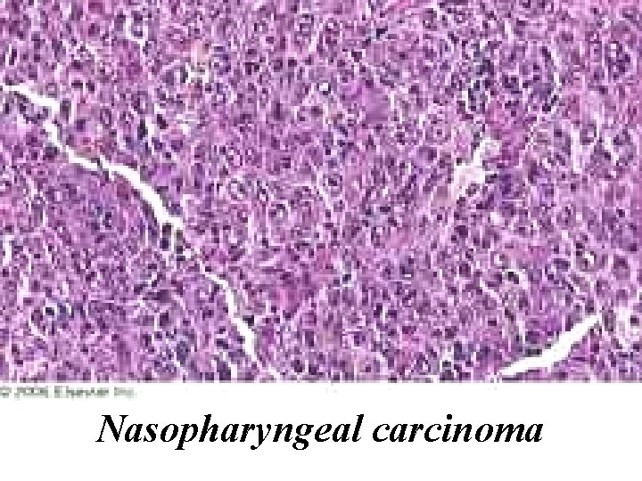 Nasopharyngeal carcinoma 