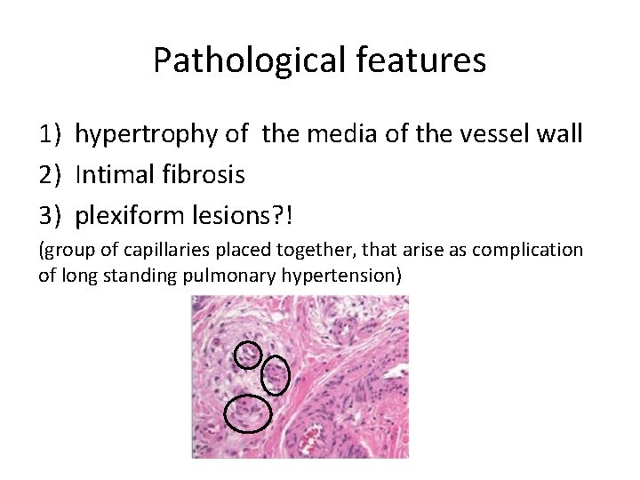 Pathological features 1) hypertrophy of the media of the vessel wall 2) Intimal fibrosis