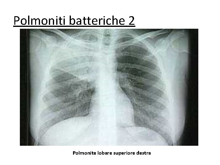 Polmoniti batteriche 2 Polmonite lobare superiore destra 