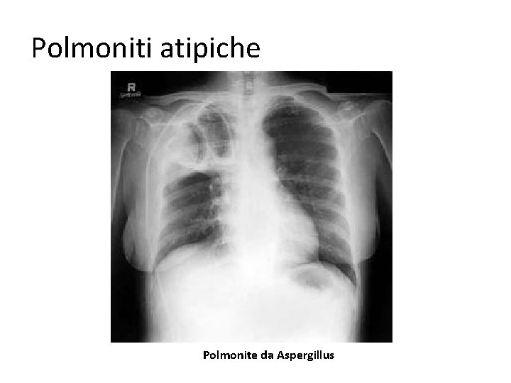 Polmoniti atipiche Polmonite da Aspergillus 