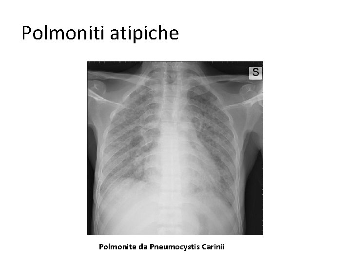 Polmoniti atipiche Polmonite da Pneumocystis Carinii 