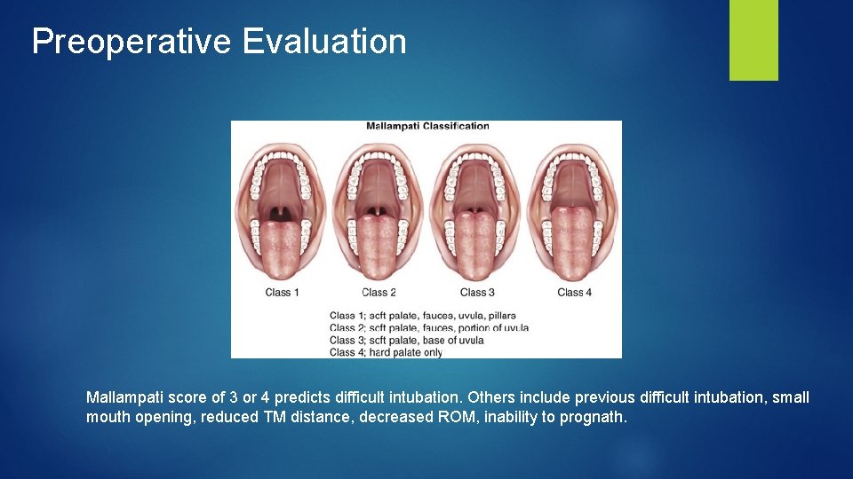 Preoperative Evaluation Mallampati score of 3 or 4 predicts difficult intubation. Others include previous