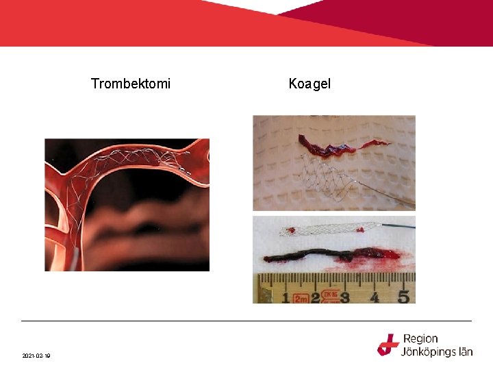 Trombektomi 2021 -02 -19 Koagel 