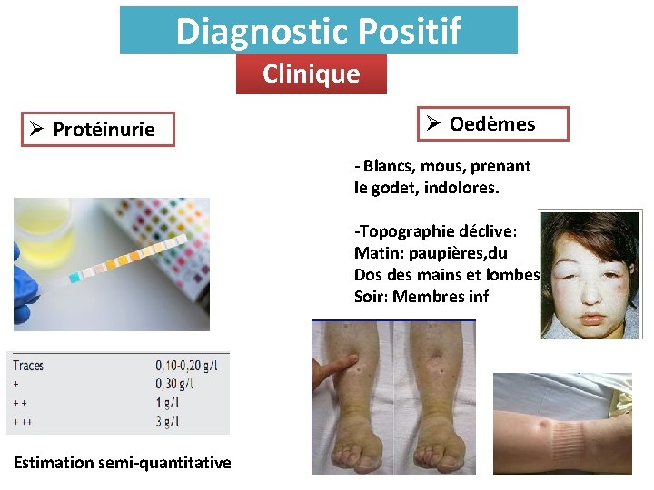 Diagnostic Positif Clinique Ø Protéinurie Ø Oedèmes - Blancs, mous, prenant le godet, indolores.