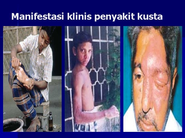 Manifestasi klinis penyakit kusta 